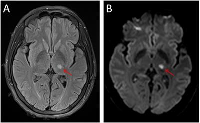 DTI-ALPS: An MR biomarker for motor dysfunction in patients with subacute ischemic stroke